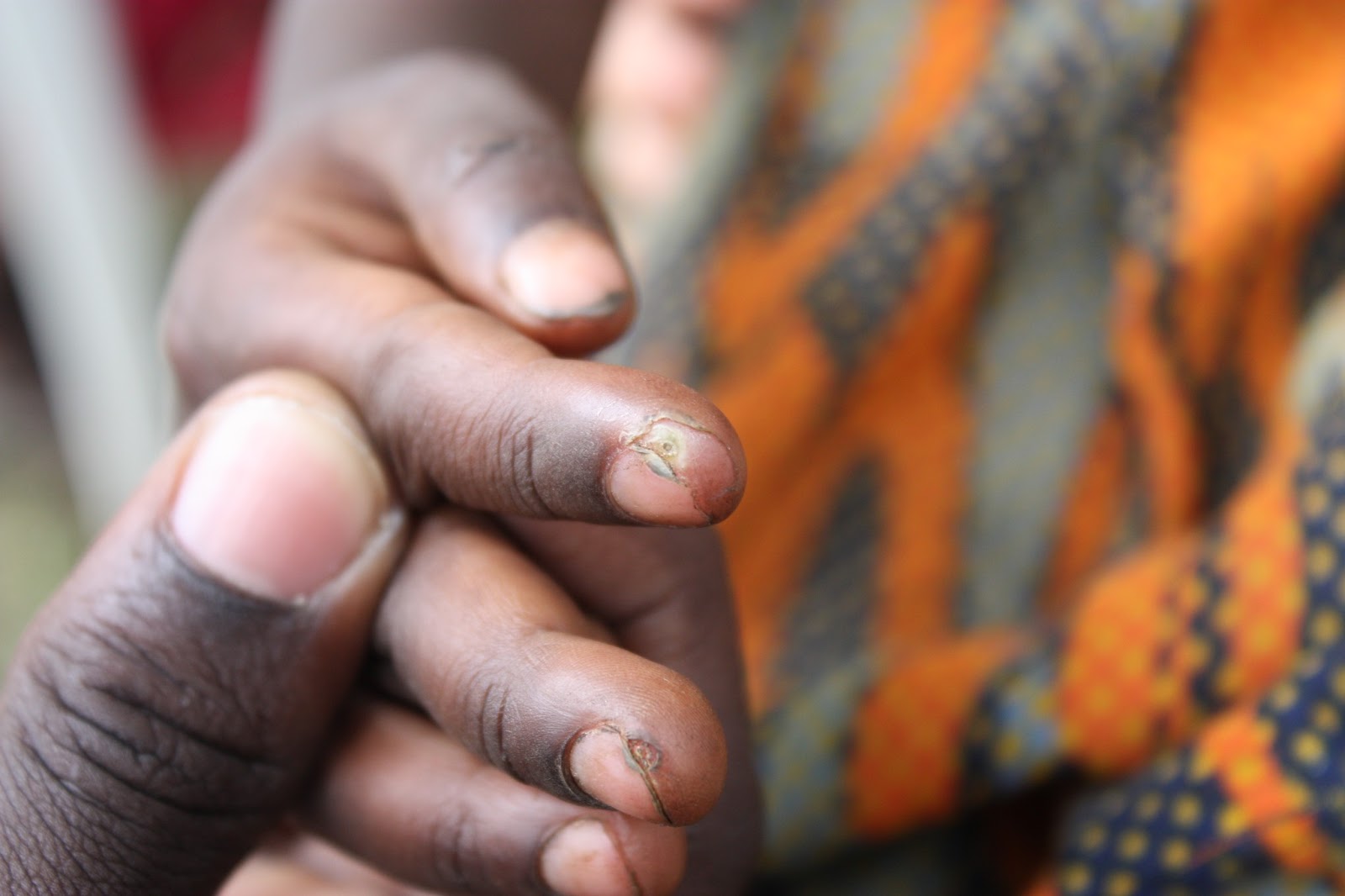 El Supositorio La pesadilla de los Jiggers (Envunza)