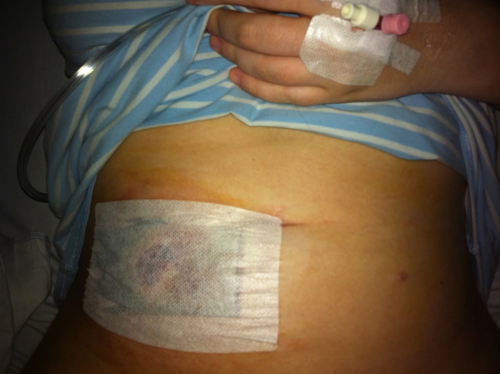 Me, Myself and Crohns Disease Ileostomy Reversal.
