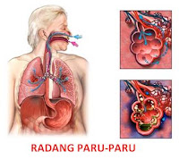 obat+herbal+radang+paru-paru.jpg