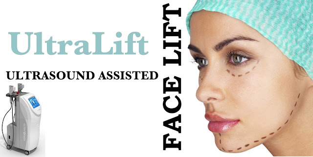 Ultralift, Ultrasound assisted facelift