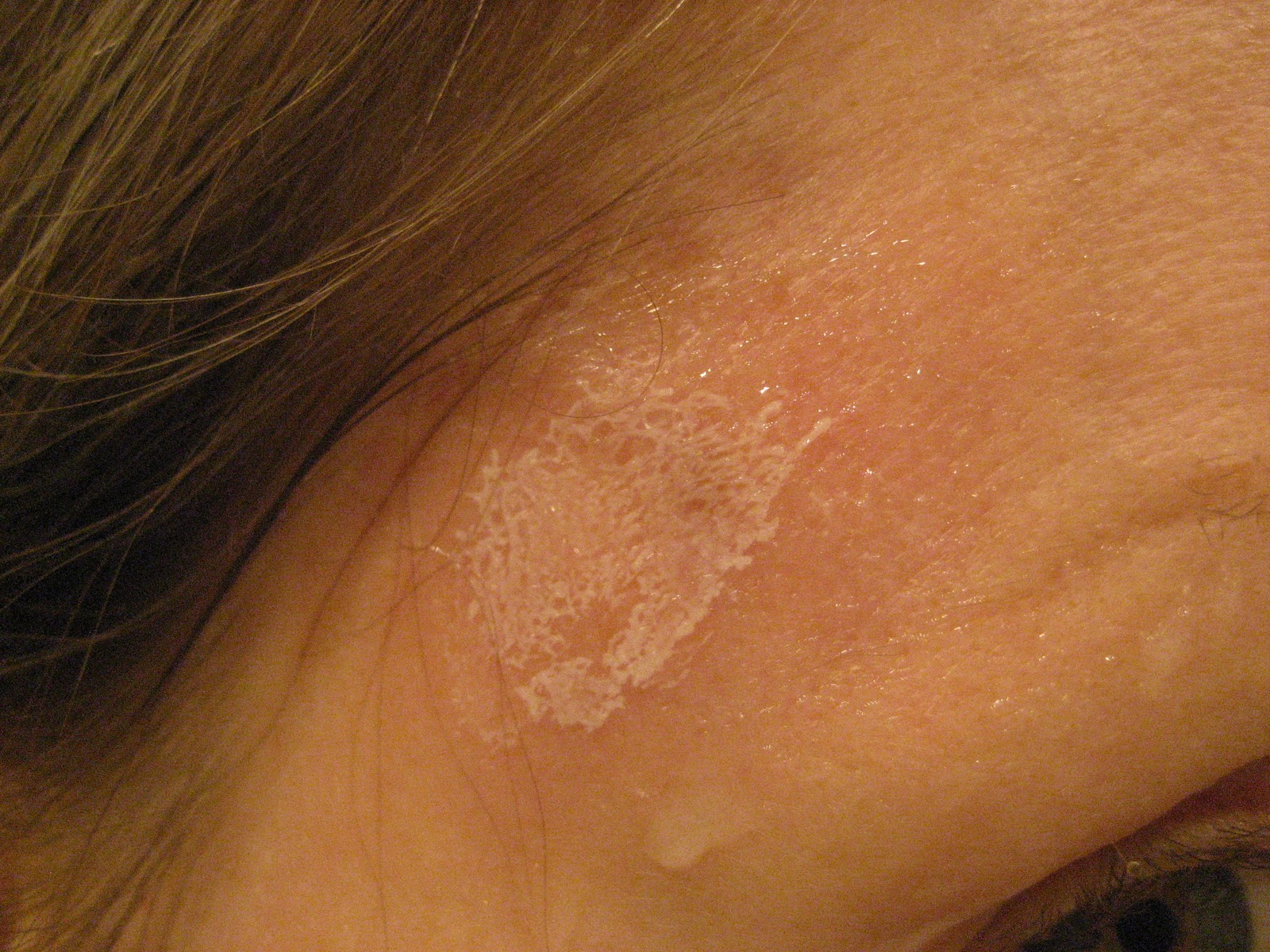 Severe Recalcitrant Nodular Acne Icd 10