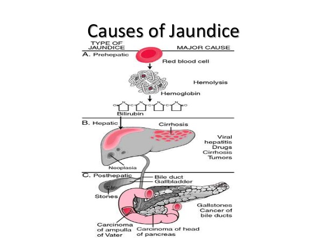 jaundice symptoms The management of obstructive jaundice obstructive jaundice is a particular type of jaundice and occurs when the essential flow of bile to the intestine is blocked. jaundice symptoms The management of obstructive jaundice obstructive jaundice is a particular type of jaundice and occurs when the essential flow of bile to the intestine is blocked.