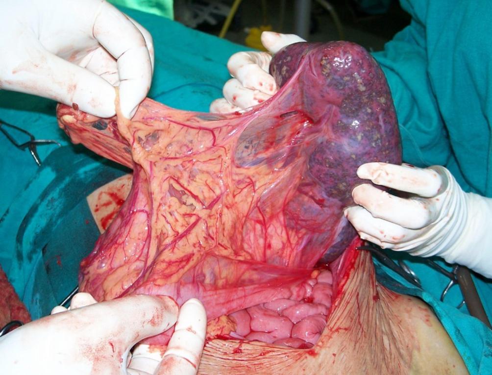 Spleen Photo