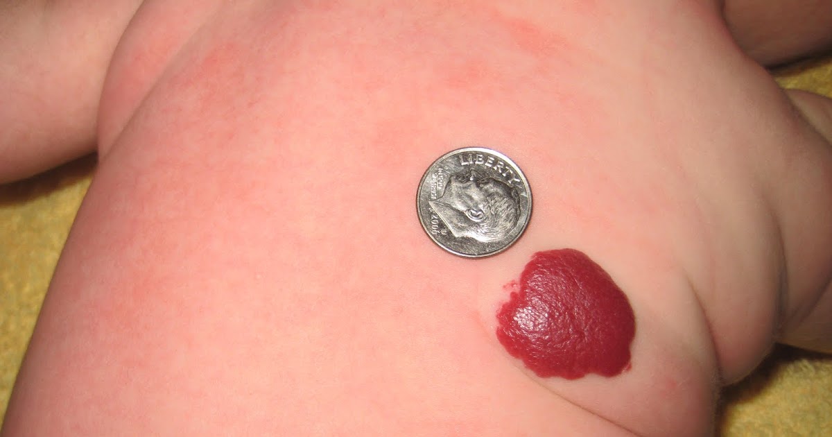 beautiful hemangioma: What is a hemangioma?