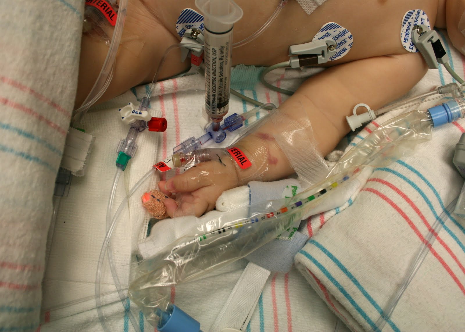 A Line Arterial Monitoring : A story of two moms surgery in photos
