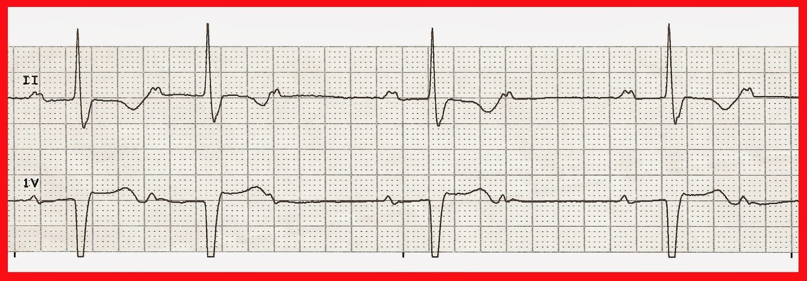 Float Nurse Various 2nd Degree Heart Block Type II