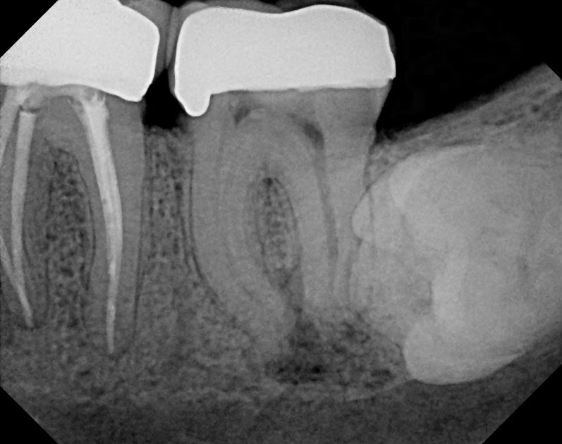 The Endo Blog Persistent PostTreatment (Apical) Periodontitis.