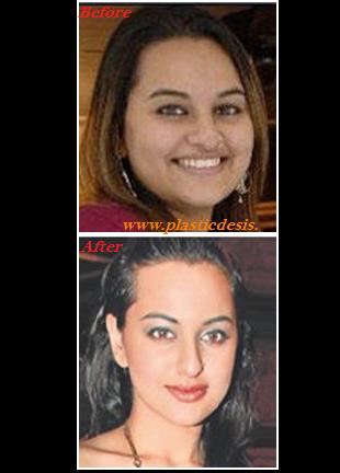 Gauri Khan Plastic Surgery on And Botox Urmila Back In The Day Maillaika Arora Khan Lip Augmentation
