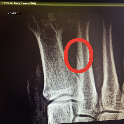 Mai Running Addiction: 2nd Toe Metatarsal Stress Fracture: 2nd doctor visit