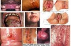 Obat Herbal Sipilis Obat Herbal Sipilis