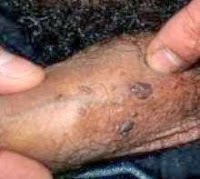 Obat Kutil Kelamin Tradisional Tanpa Bahan Kimia Obat Kutil Kelamin Tradisional Tanpa Bahan Kimia