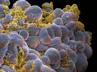 Las celulas madre del cáncer ¿Qué son? Celulas+madre