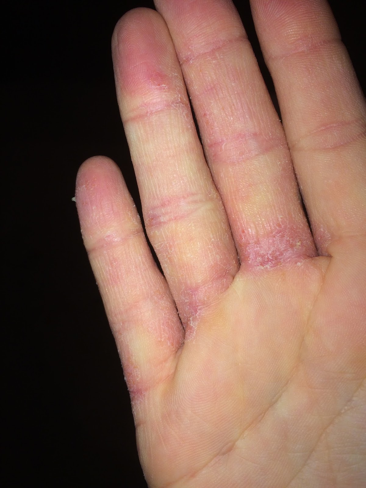 Ditch The Itch 21.5 months