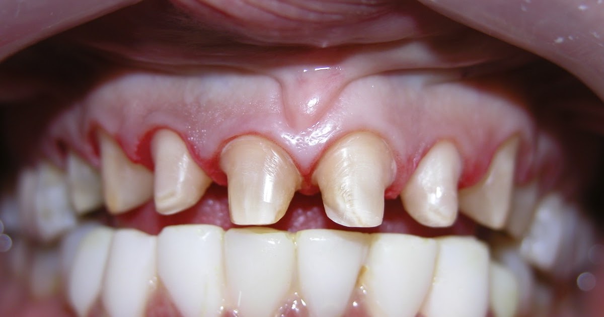 Denthrone Crowns vs. Veneers Part II