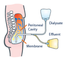 peritoneal dialysis immunotherapy