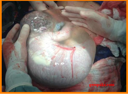bayi dikeluarkan daripada Perut Ibunya masih dalam Uri Bayi+dlm+uri