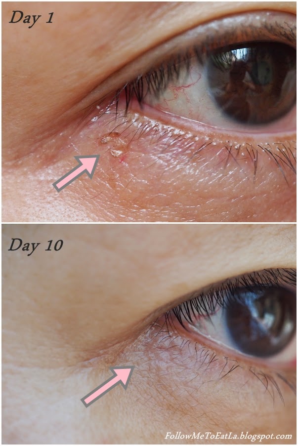 Follow Me To Eat La Malaysian Food Blog CO2 Laser for Removal of Milia/Oil Seeds Mediviron UOA