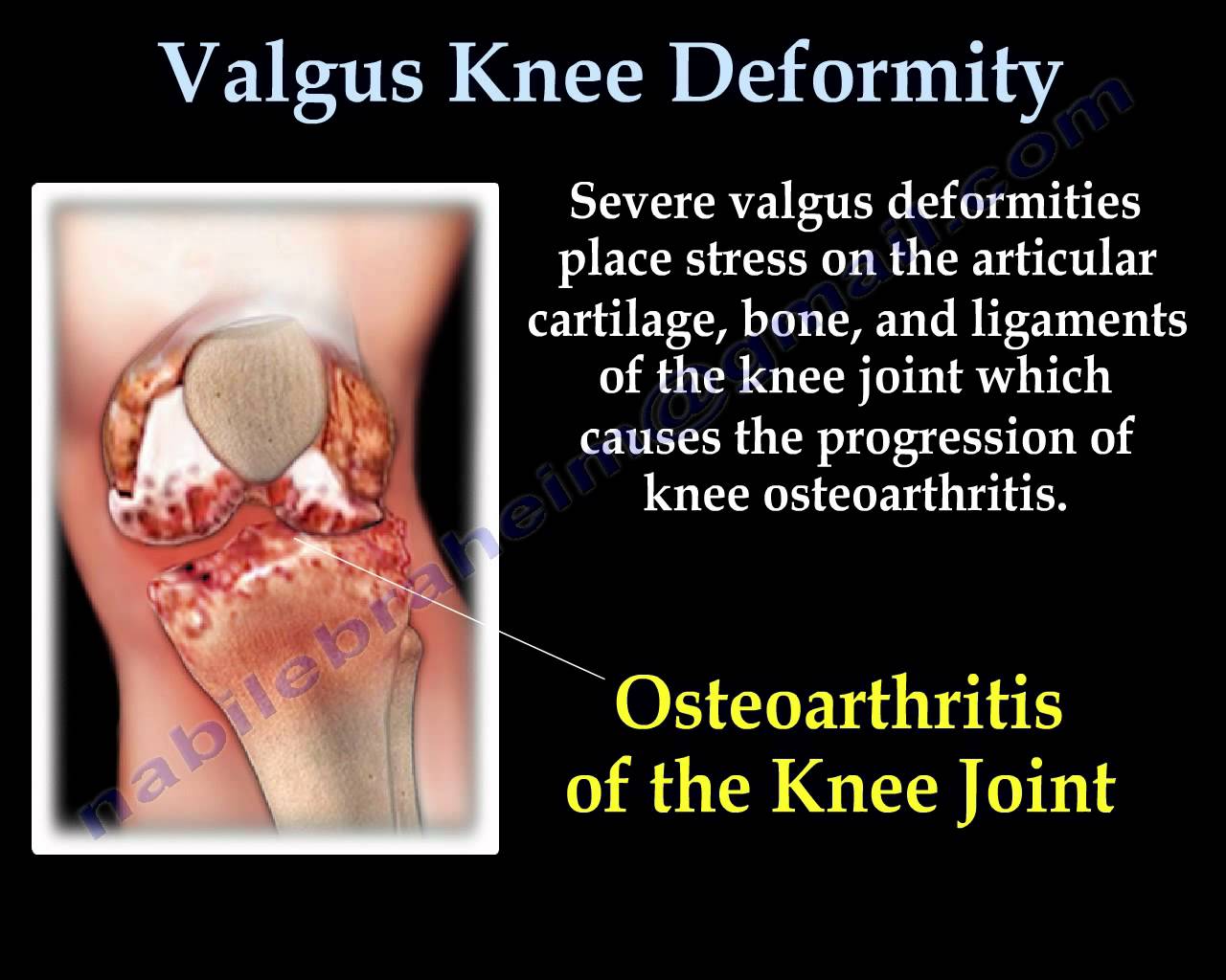 Reasonably Well: The Knee Bone is Connected to the Hip Bone...