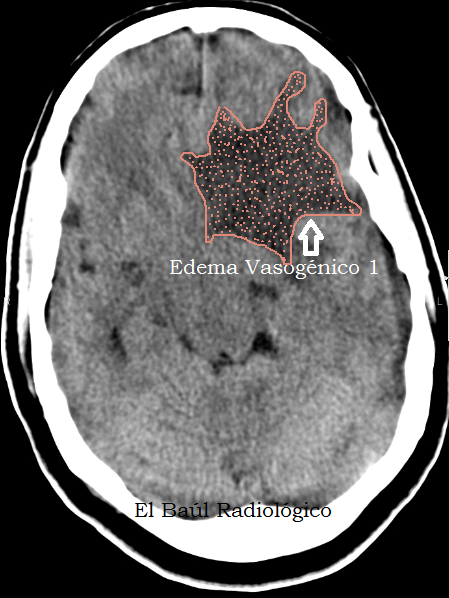 Edema+dibujo.png
