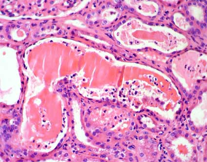 Horses And Zebras Renal Disease In Multiple Myeloma