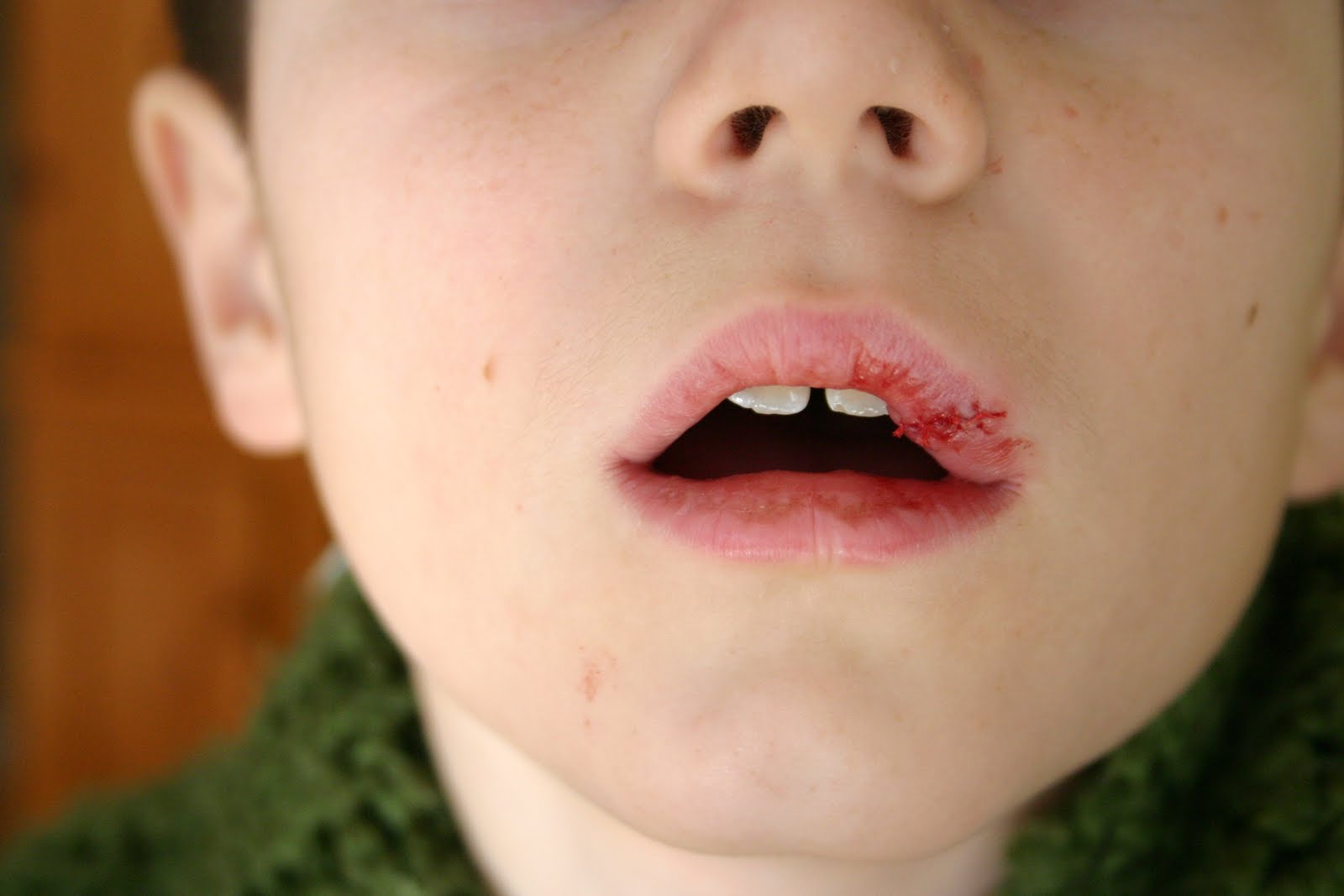 My Perspective Kyle's Busted Lip 1/22/11