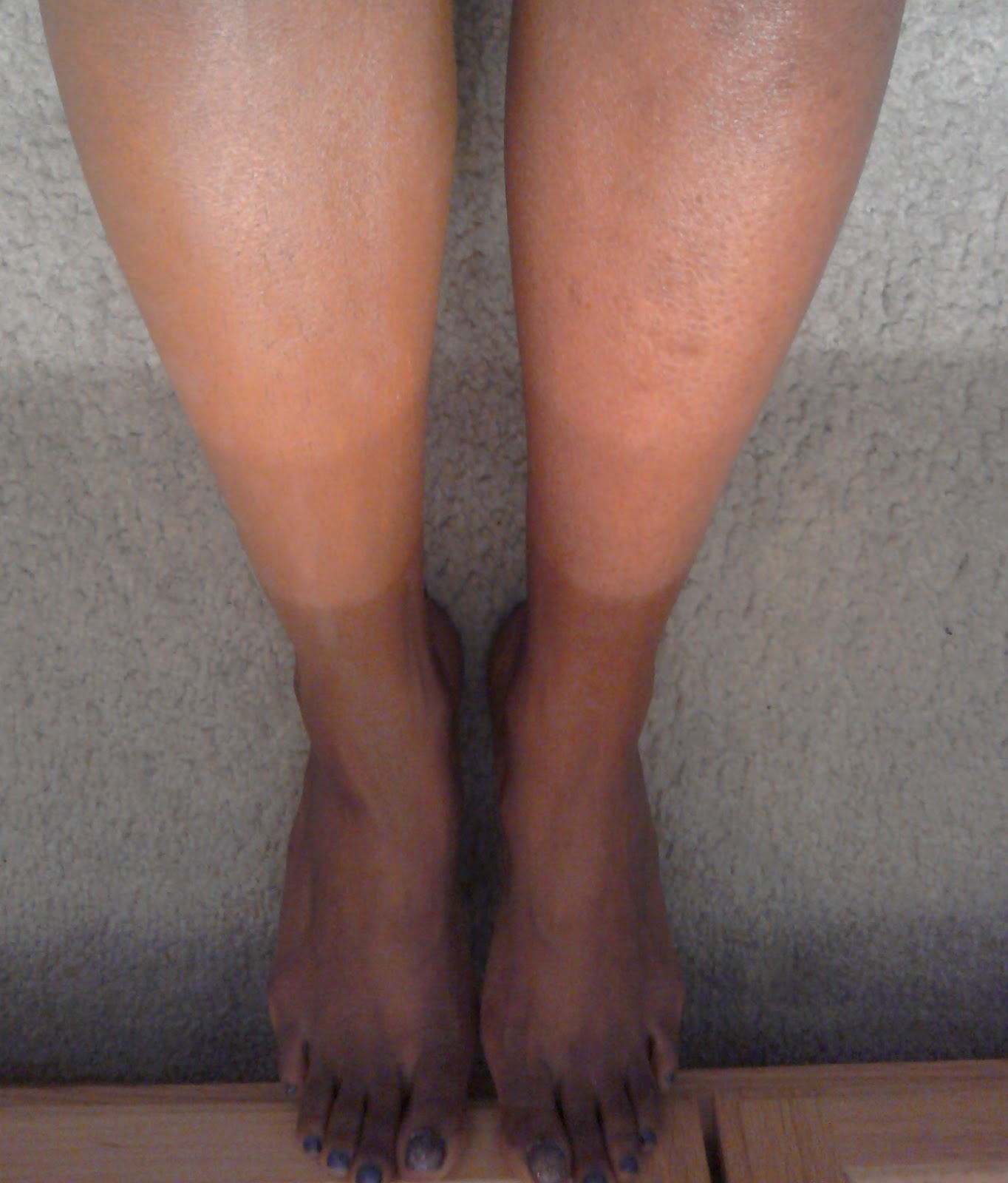 Leg Stretch Marks
