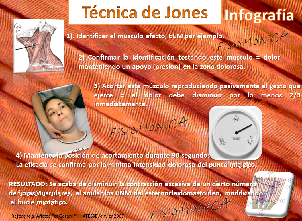 FISIOMÓNICA Técnica de Jones (Infografía)