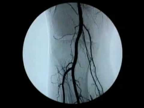 Exame de arteriografia