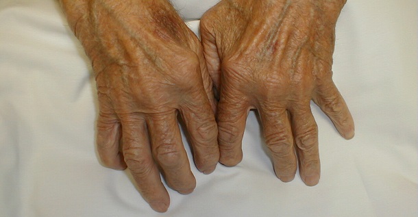http://www.ciencia-online.net/2013/06/artrite-reumatoide-sintomas-e-tratamento.html