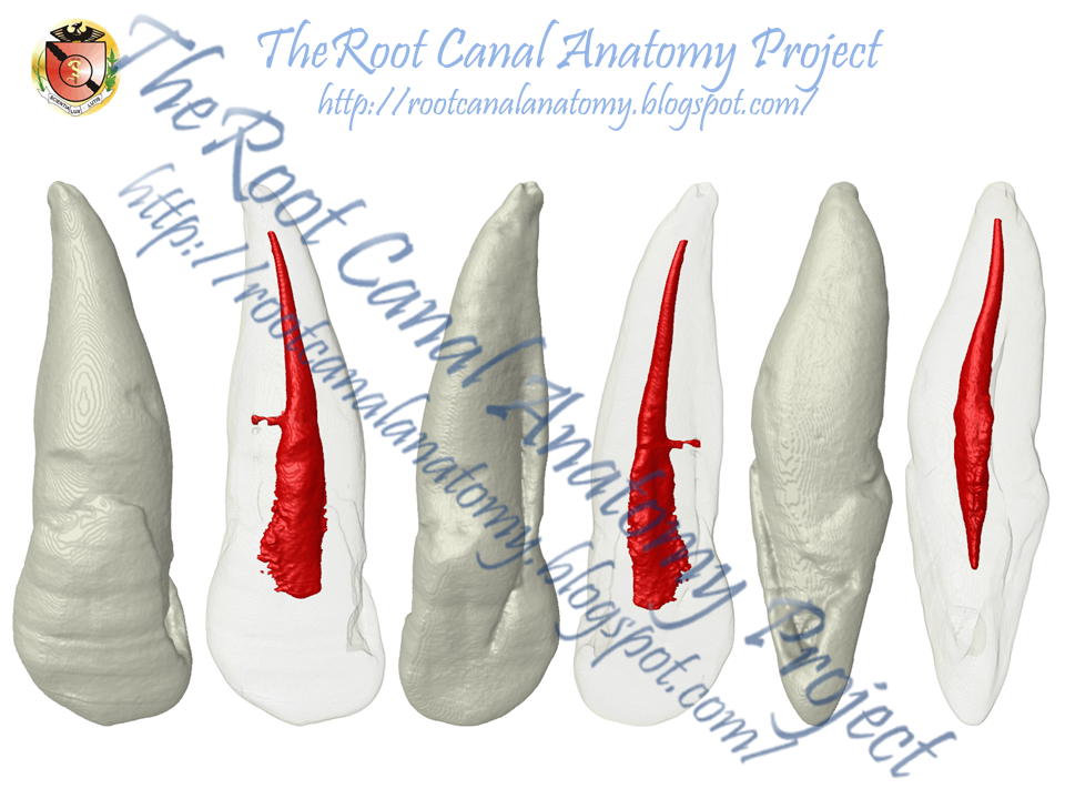 The Root Canal Anatomy Project Radicular Groove Maxillary Incisors