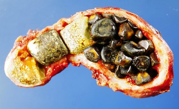 Gallstones