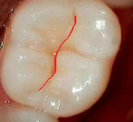 Anatomia Dental en esta imagen se muestra el surco central de un molar