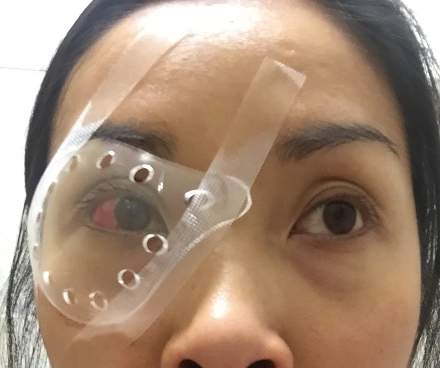 My eye Pterygium excision round 2 with Dr Franz Michel