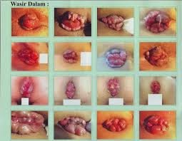 obat wasir, setadium 4