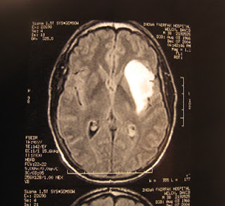Symptome tumeur cerveau