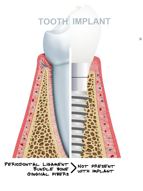 The Endo Blog Are Dental Implants Forever?