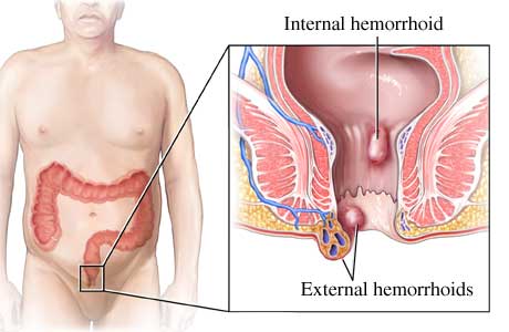 Nursing Care Plan for Hemorrhoids