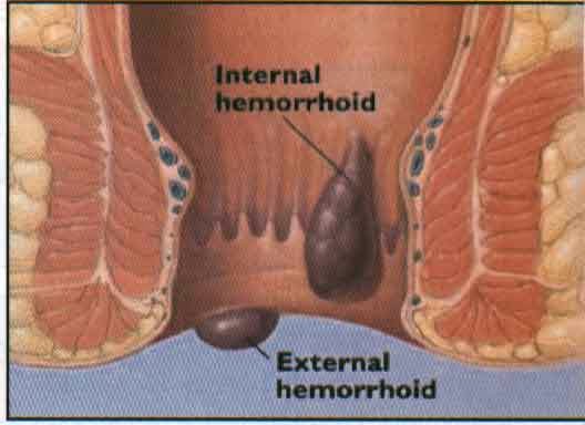 obat ambeien masuk dubur, obat ambeien atau hemorrhoid aman ibu hamil, obat ambeien tradisional paling mujarab