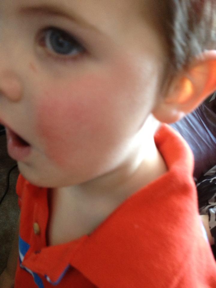 Tales of Mommyhood Fifth's Disease