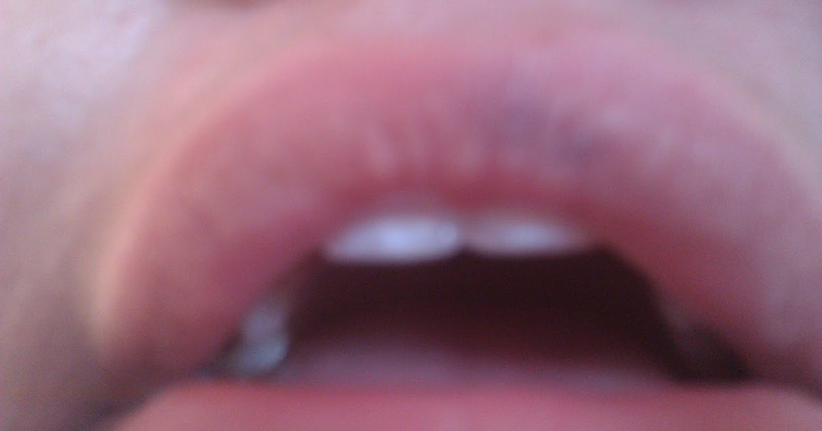 It's All Relevant Hickey Lip