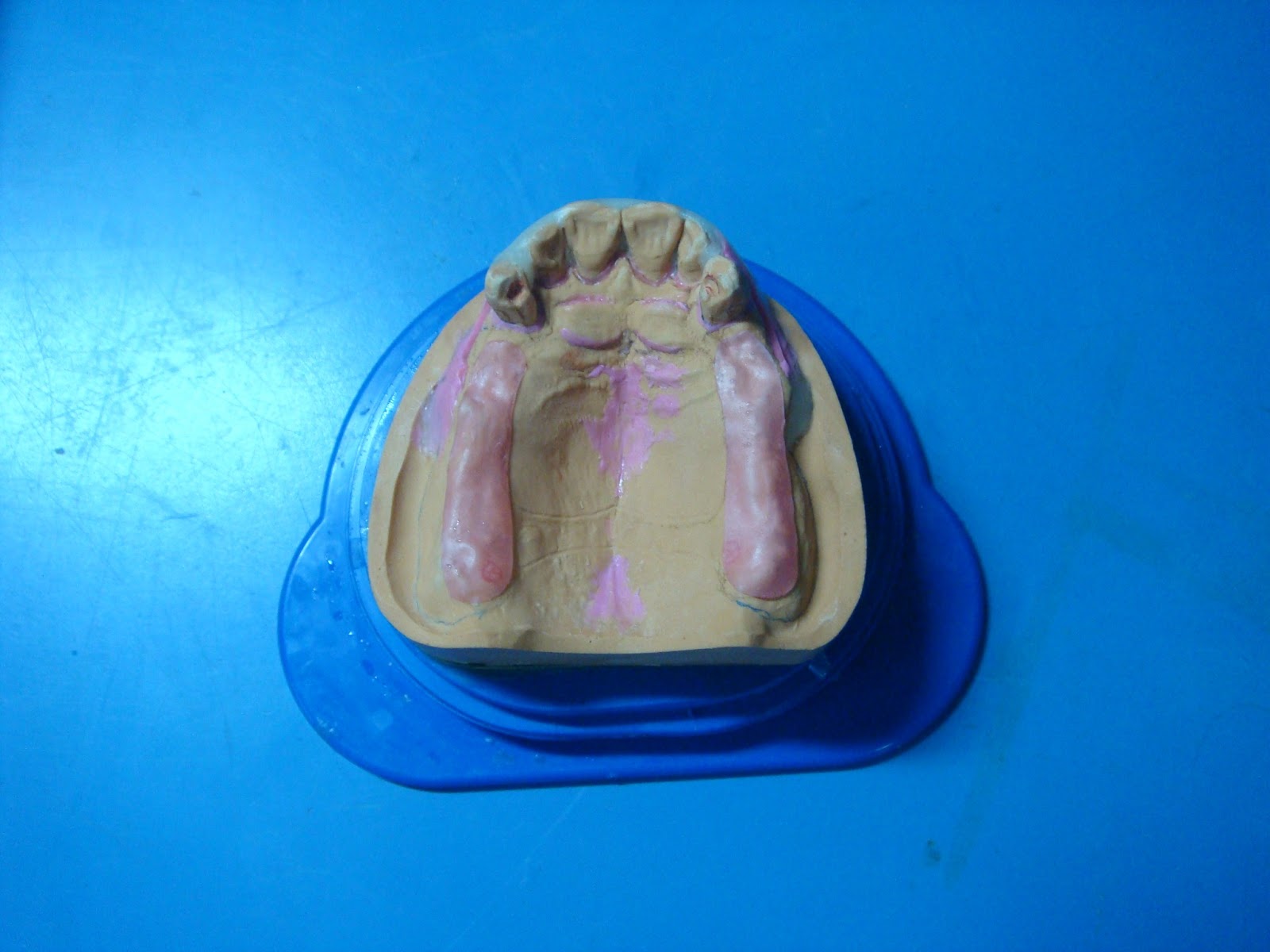 Step by step Guide for Understanding the Prosthodontics A step by step