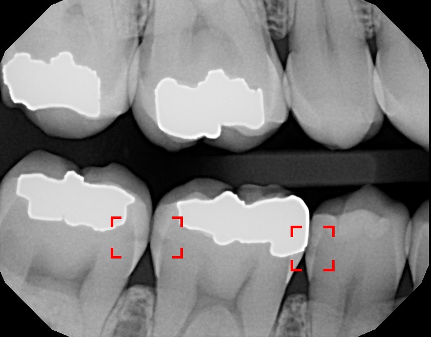 Help Your Mouth How Much Radiation Is in a Dental XRay?