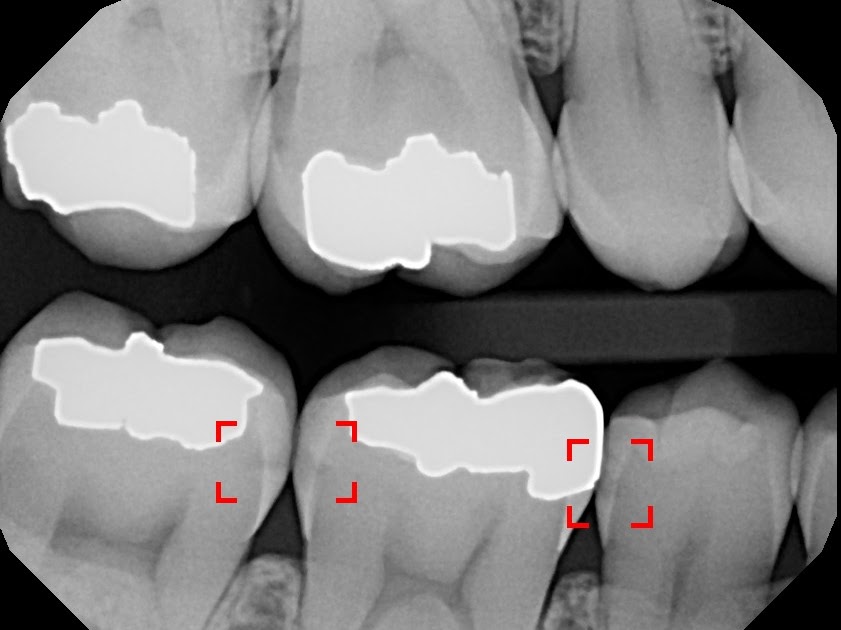 Help Your Mouth How Much Radiation Is in a Dental XRay?