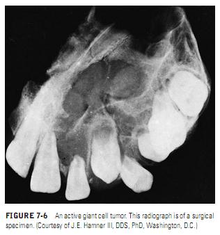 Кольцевидная гранулема фото лечение