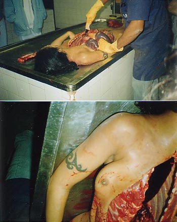 Autopsia Em Cadáver Feminino 