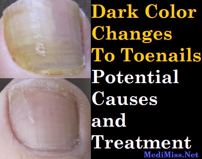 Dark Color Changes To Toenails Potential Causes and Treatment SkinnyZine