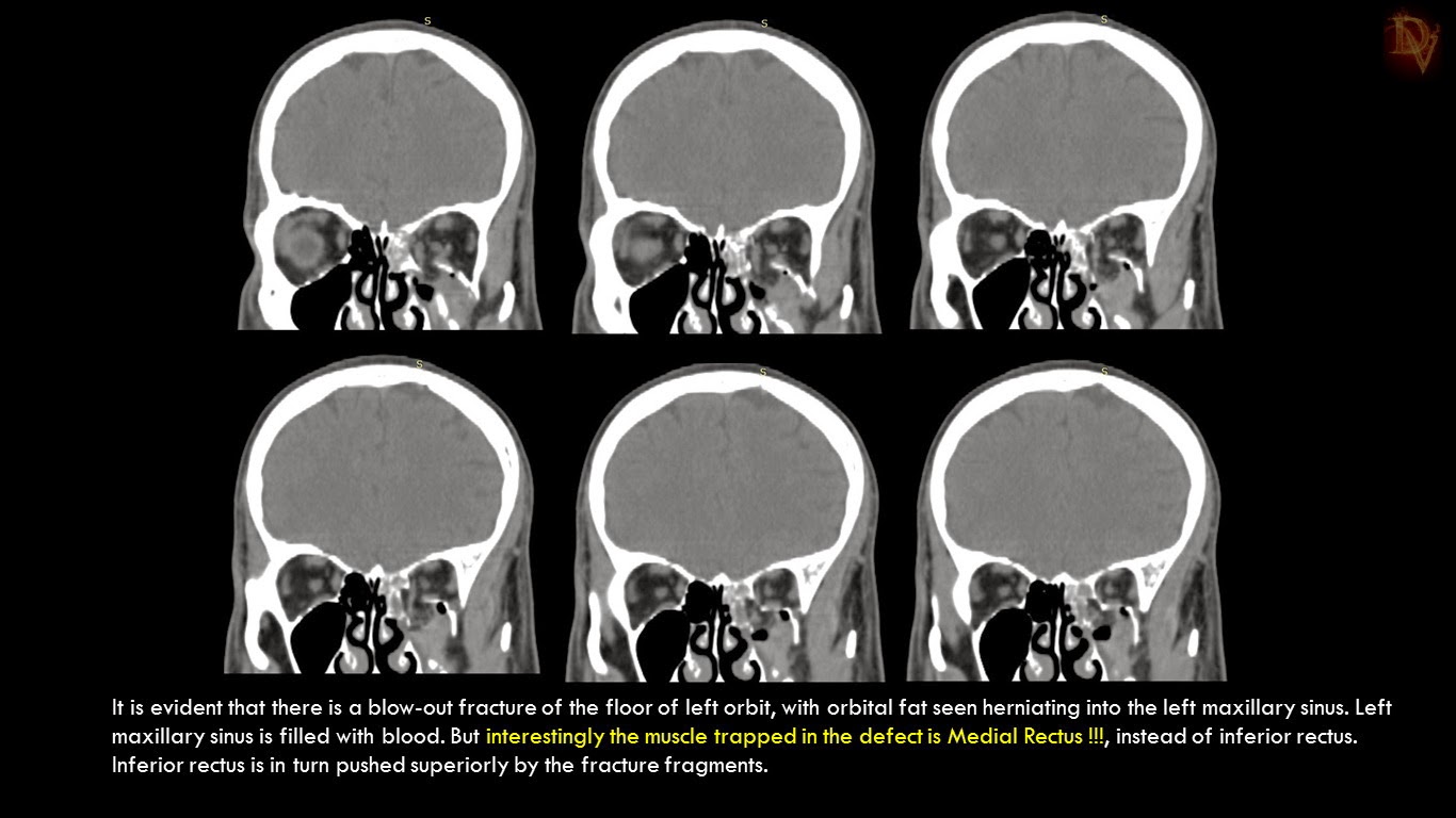 Ultimate Radiology Orbital Blowout Fractures
