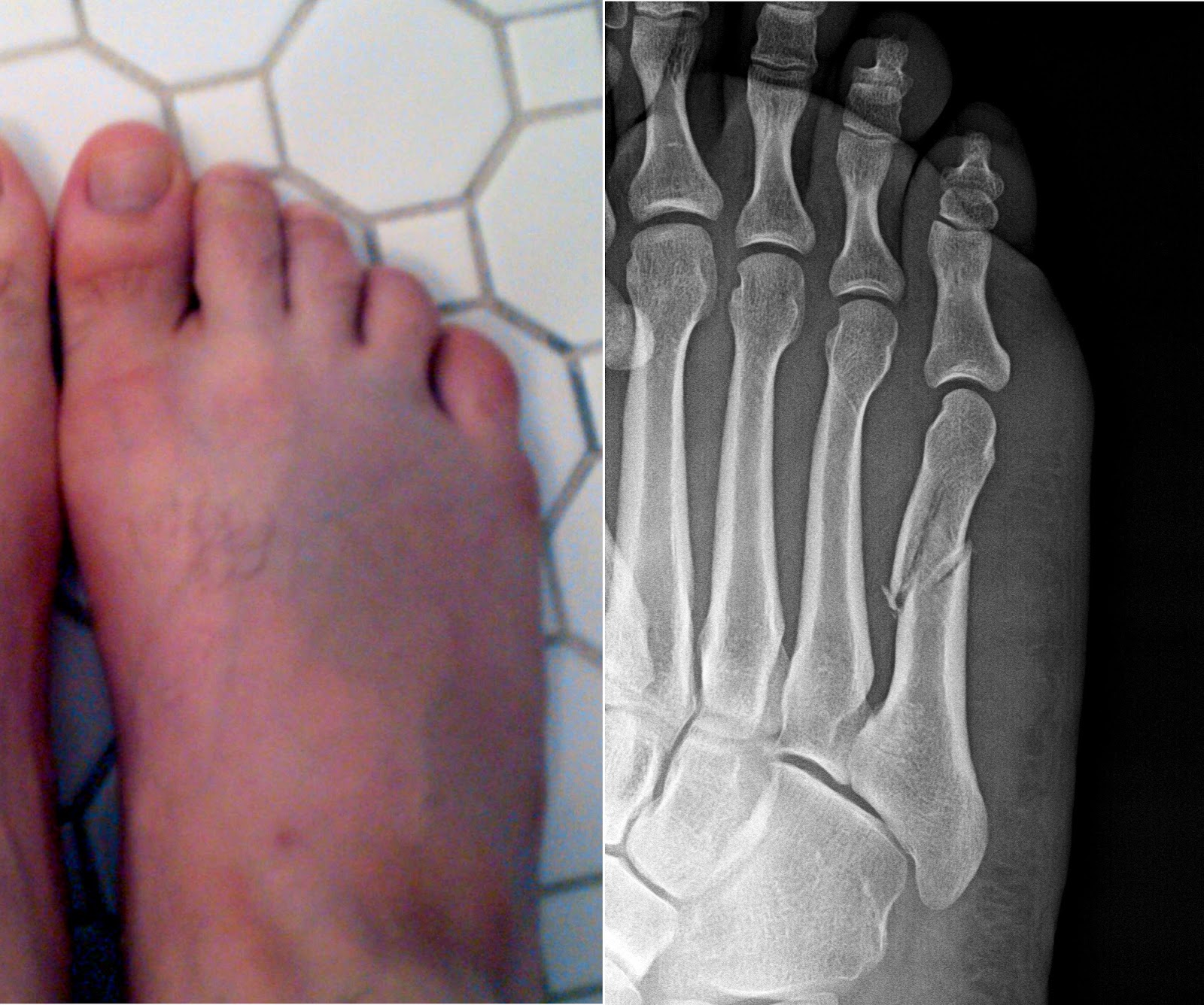 5th metatarsal fracture