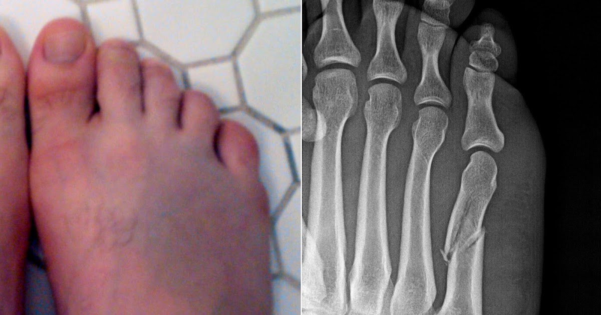 Fractured Ankle Symptoms Fracture Treatment