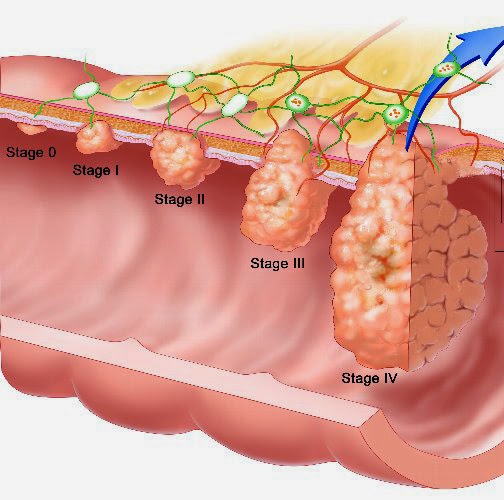 kolon kanseri kalin bagirsak kanseri blogger